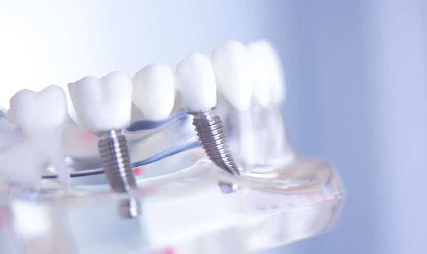Comparing Dental Implant Options in Lubbock: A Guide to Choosing the Right Type
