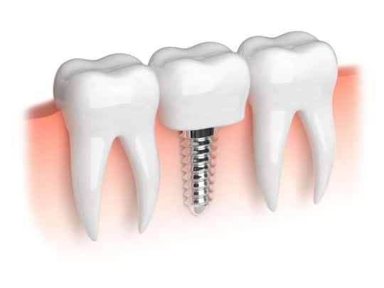 Sounding Your Best: How Dental Implants Boost Speech Confidence | Dental  Group of Lubbock