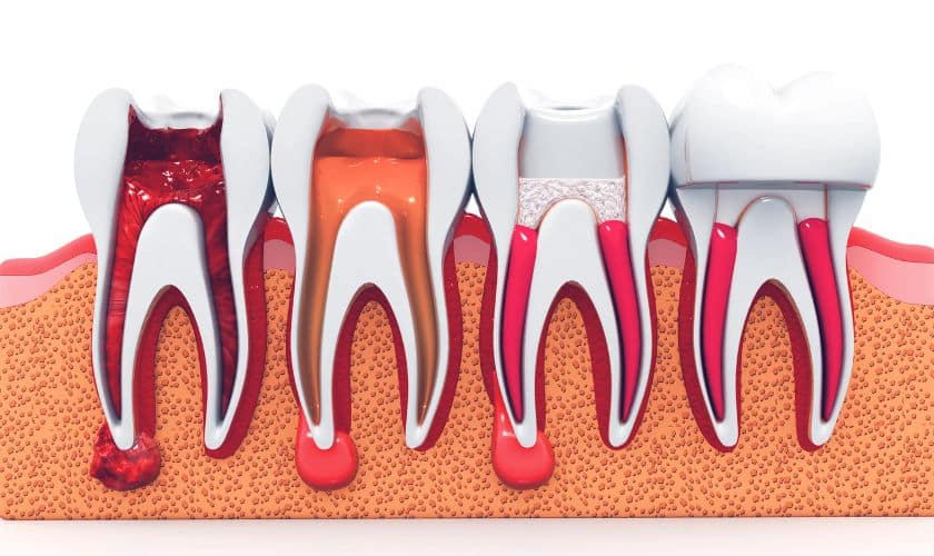 Post-Root Canal Care: Reducing the Risk of Infections