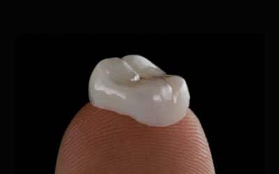 Tips to Get the Most Affordable Dental Crowns