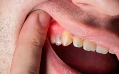 The Truth About Canker Sores: Why They Appear & How to Stop Them