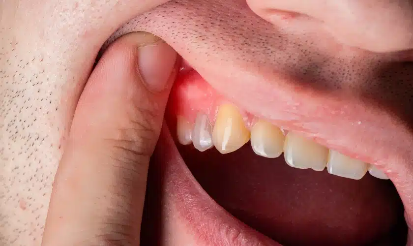 Illustration depicting a mouth with a canker sore on the inner gum, surrounded by healthy teeth.